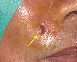 図1 右鼻翼外側縁の皮膚腫瘤。10×10mm大の弾性硬、暗褐色腫瘤(矢印)