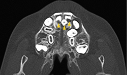>図2　CT像（矢頭：３本の上顎正中過剰埋伏歯）