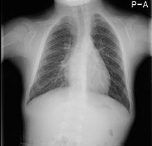 図3  胸部単純Ｘ線写真（釣鐘状の胸郭）
