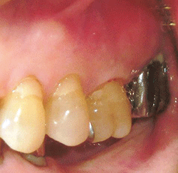 >a：口腔内写真 図1 初診時（上顎左側臼歯部