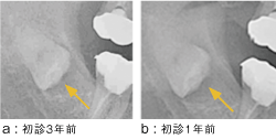 a：口腔内写真 図1 初診時（上顎左側臼歯部 