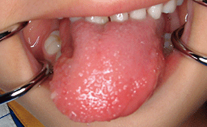 >図1 初診時（4歳）の舌