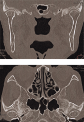 図4 CT画像。顎骨の骨髄炎像や膿瘍形成、顎関節部の癒着、顎関節腔の拡大は認められなかった