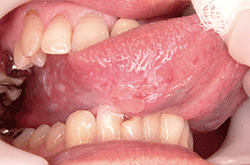 >図1 初診時の右舌縁の所見