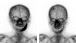 >図3 骨シンチグラム。初診時（左）、腐骨分離後（右）