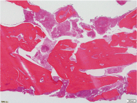 >図4 下顎骨骨髄炎の病理組織写真