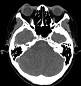 図2 CT画像。頭頸部領域に、疼痛の原因となりそうな病変は描出されていない