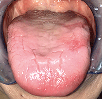 図1 初診時口腔内写真。舌乳頭の萎縮、発赤、一部びらん、溝状舌を認める