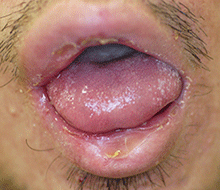 図2 舌、下唇粘膜部に白色偽膜の多発を認める