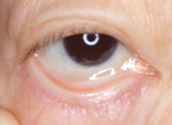 図1 眼瞼結膜に蒼白感がみられる