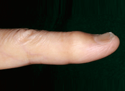 図2 示指の爪の変形