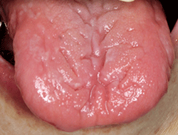 図4 軽度の溝舌を伴う舌乳頭の萎縮