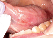 図1 初診時の舌所見