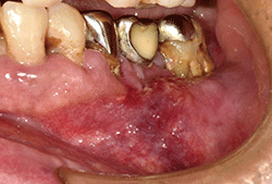 図1 初診時の口腔内写真
