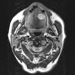 図2 初診時のMRI画像（T2強調像）