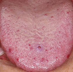 図1 舌の点状紫斑