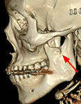 ｂ：左側下顎切痕部に損傷（矢印）