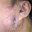 図1 当科初診時、耳下部からの排膿と腫脹を認めた
