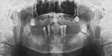 図3 初診時のパノラマＸ線写真。左下顎枝に智歯の埋伏と周囲の骨吸収を認める