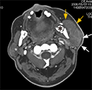 図4 初診時の造影CT所見。腫脹した左耳下腺（白矢印）と左咬筋（黄矢印）を認める。また、埋伏歯（＊）が左下顎枝にみられた