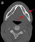 図1 初診時のパノラマＸ線写真