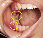 図1 顎右側臼後部舌側歯肉、ならびに歯間乳頭部に一部壊死化した組織を認めた