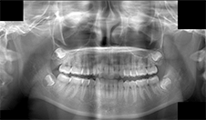 図2 右下大臼歯部に骨の異常所見はあきらかではなかった