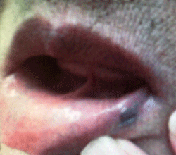 図1 下口唇の病変部