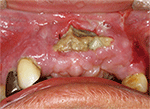 図1 初診時の口腔内写真。上顎唇側歯肉から腐骨が露出し、排膿が認められる