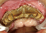 図2 初診から約１年の口腔内写真。上顎歯槽骨の全体が壊死し、露出した状態。上顎唇側歯肉は退縮し、口蓋歯肉は捲り上がっている