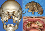 図3 上顎脱落時の口腔内写真。脱落した上顎および３DCT画像