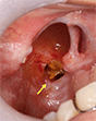 図5 上顎脱落後９ヵ月の口腔内写真。翼口蓋窩に骨の露出と排膿を認める