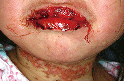 図1 頸部の皮膚に紅斑、びらんを認める