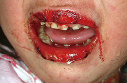 図2 口唇に血性痂皮の付着と流涎を認める
