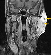 図2 MRI（造影T1強調像）。矢印：不均一に造影されている中に造影されていない部位を含む病変