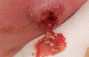 図3 膿瘍自潰部より排出した菌塊