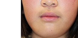 図1 初診時の顔貌は右下顎にびまん性の腫脹を認めた