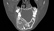 図4 CT所見では病巣と周囲骨との境界は比較的明瞭であった