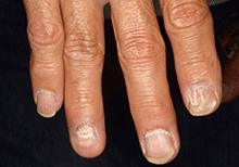 図1 右第２、４指爪の角化の亢進