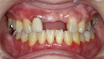 図1 上下顎の歯肉に発赤を認め、剥離やびらんを伴う