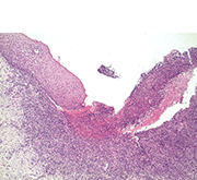 図2 上皮下に著明な炎症性細胞浸潤と、水疱形成を示す裂隙を認めた