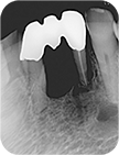 図2 抜歯前のデンタルＸ線写真