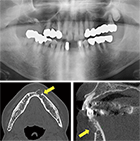 図3 初診時のパノラマＸ線写真とCT画像。抜歯窩の唇側皮質骨を膨隆（菲薄化、一部消失）させる病変を認める（矢印）