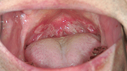 図1 口蓋垂を中心に軽度のびらんを伴う乳白斑
