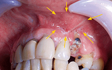 図1 初診時の口腔内写真。前装冠はパノラマＸ線写真撮影後に脱離