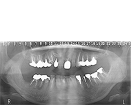 図2 初診時のパノラマX線写真
