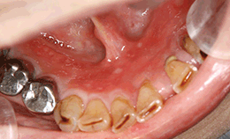図2 同、口腔内写真（下顎歯肉）