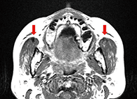 図2 初診時MRI写真。両側の咬筋は肥厚し、咬筋前縁に無信号領域を認める（矢印）