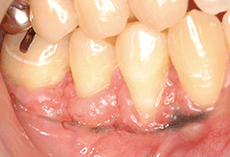 ｂ：52歳、女性。右側下顎臼歯部歯肉の色素異常を主訴に受診