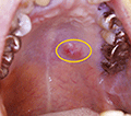 図1 初診時の口腔内写真。左硬口蓋中央部に腫瘤性病変を認める